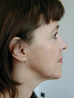 Interventions de lifting ou chirurgie esthétique du visage