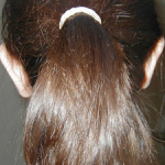 otoplastie chirurgie esthétique des oreilles