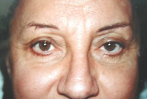 Interventions de blépharoplastie ou chirurgie esthétique des paupières