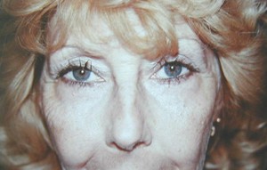 Interventions de blépharoplastie ou chirurgie esthétique des paupières