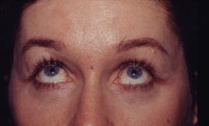 Interventions de blépharoplastie ou chirurgie esthétique des paupières