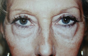 Interventions de blépharoplastie ou chirurgie esthétique des paupières